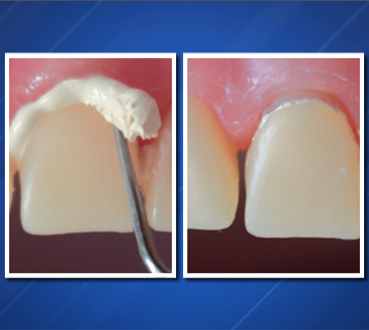 PQMP Removal